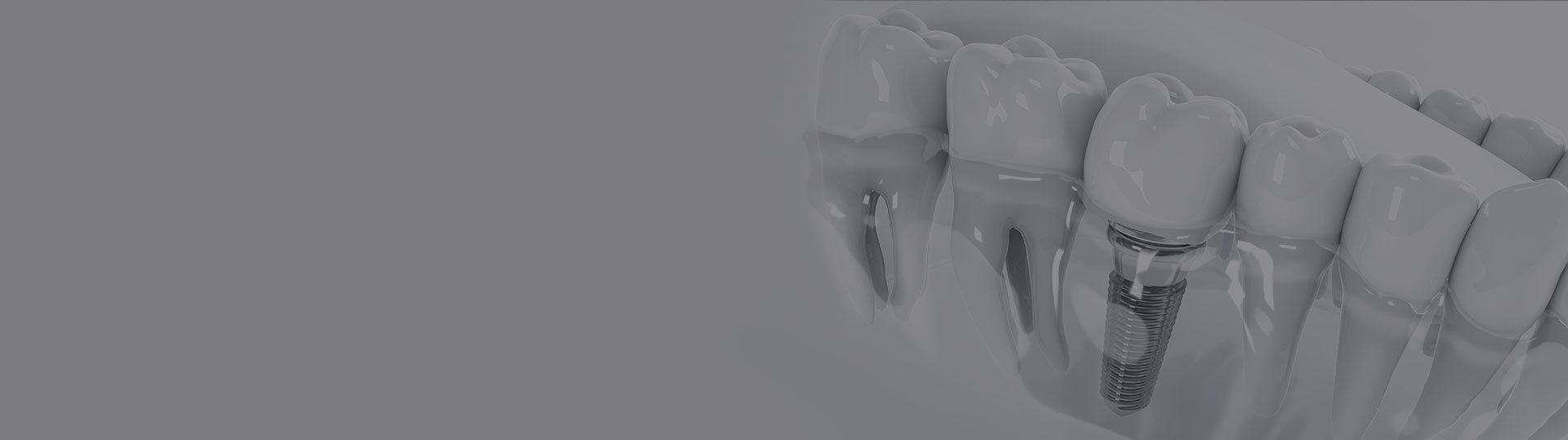 Implant Dentar Alor Esthetic Medical City