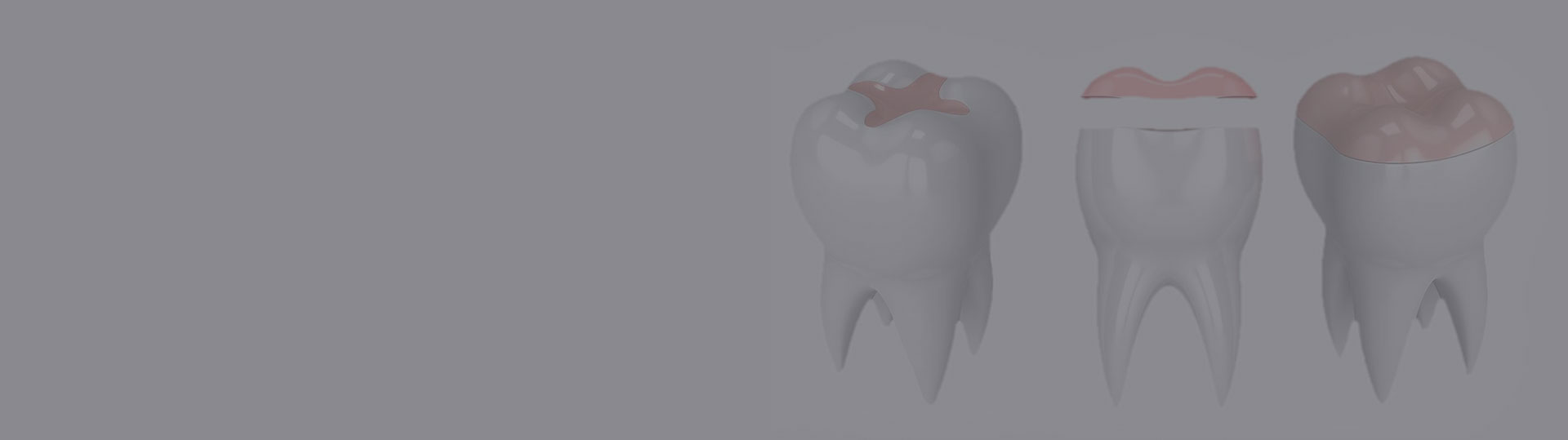 Incrustatii dentare Alor Esthetic